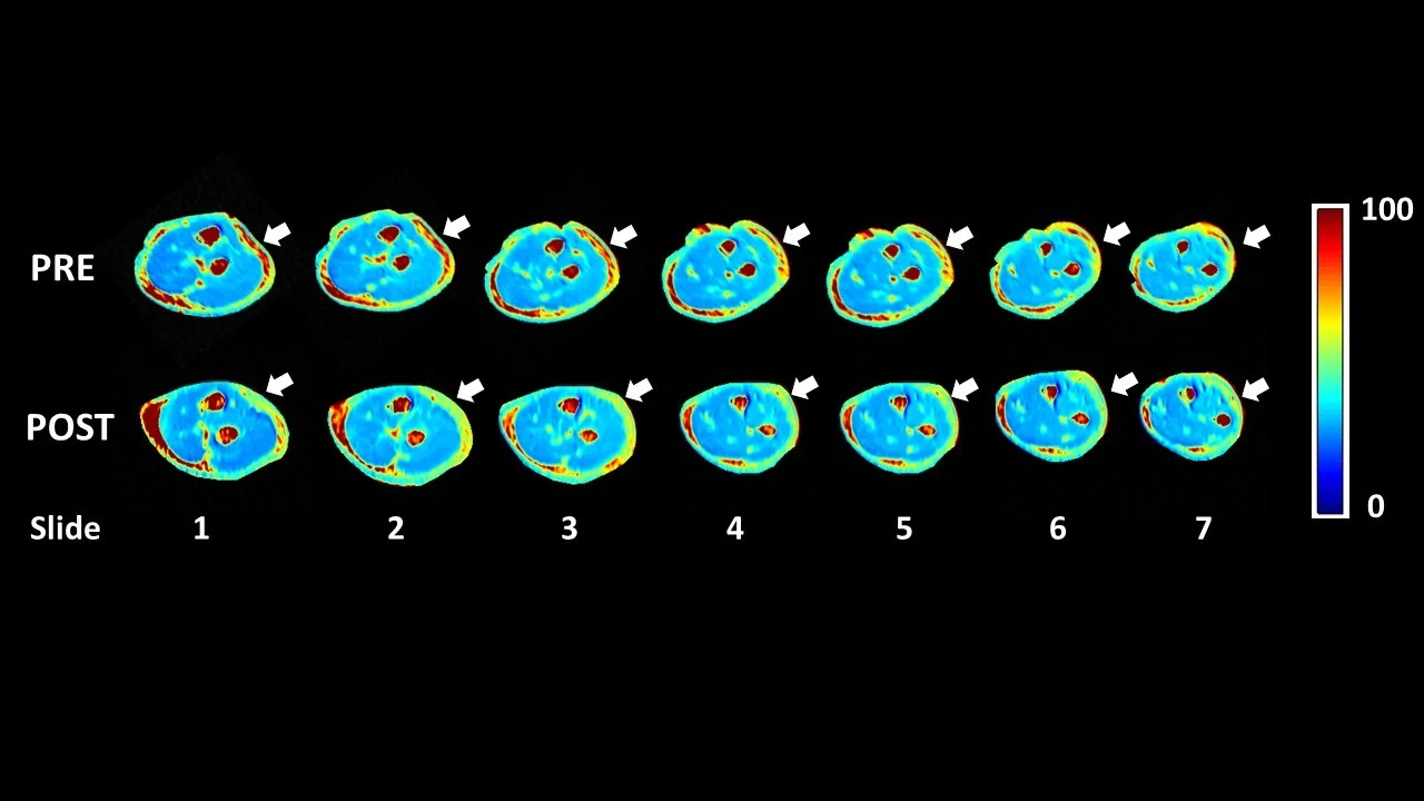 T1ρ MRI maps of the forearm before and after Fascial Manipulation — seven cross-sections showing reduction in warm-coloured unbound water signal in the brachial fascia from PRE to POST treatment