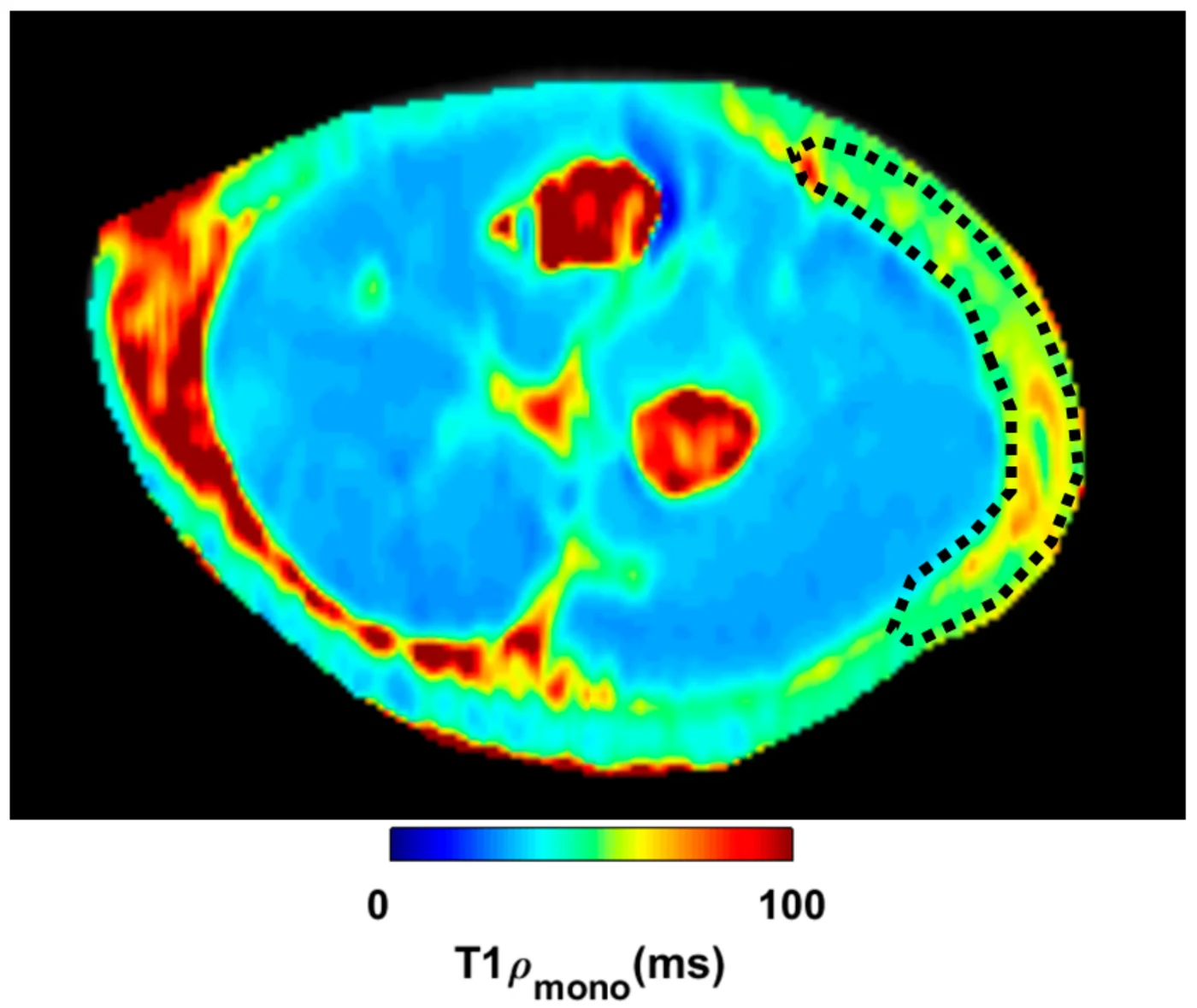 T1ρ MRI cross-section of the forearm pre-treatment — dotted outline marks the region of interest in the brachial fascia on the lateral aspect; warm red and orange colours indicate high unbound water concentration