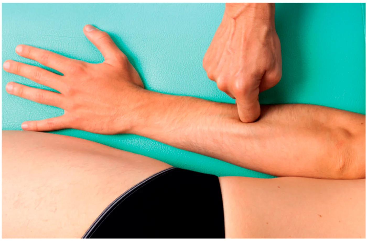 Fascial Manipulation treatment applied to the lateral forearm — sustained manual pressure at a centre of coordination in the forearm extensor myofascial unit