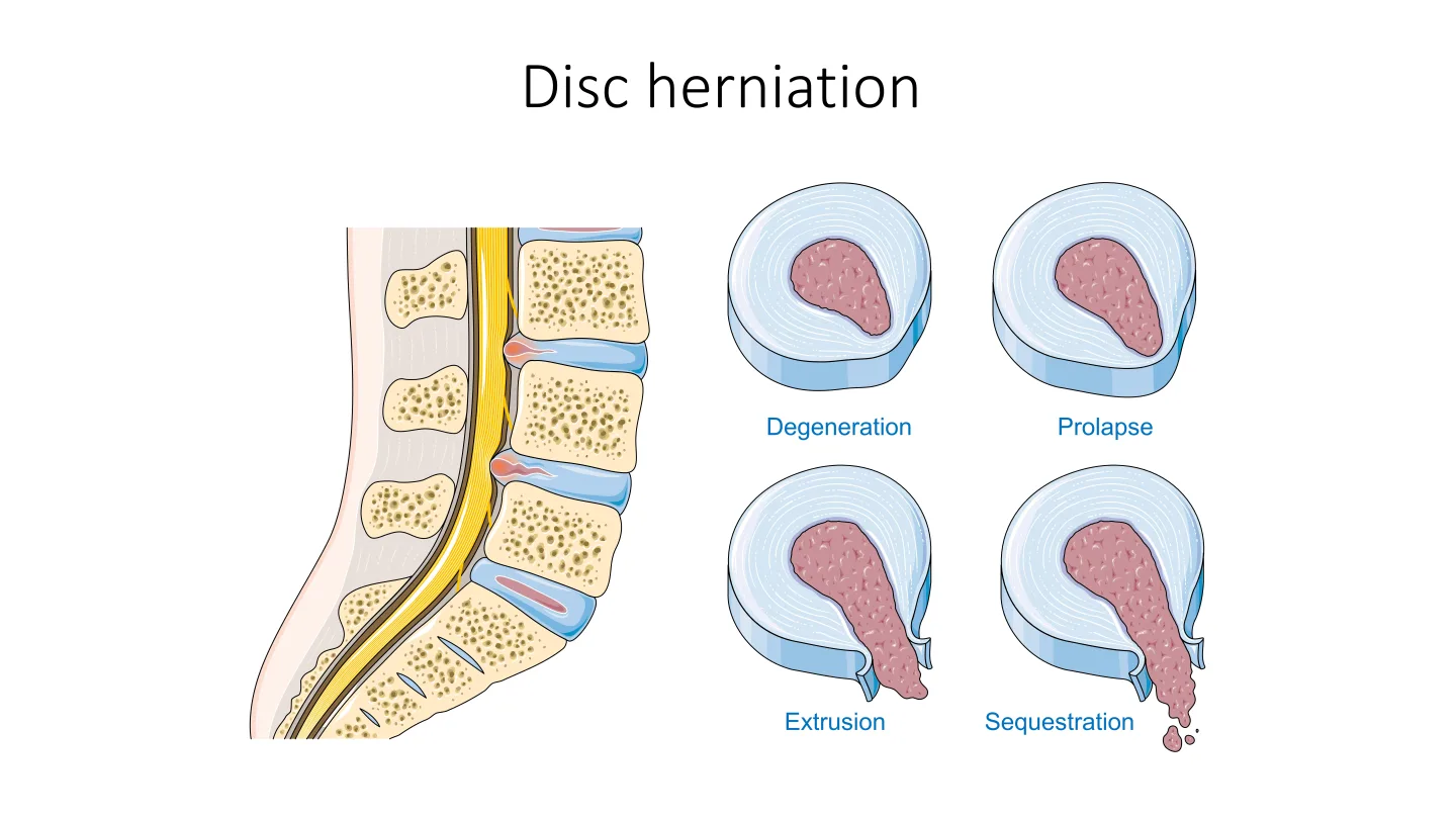 Four-stage illustration of lumbar disc pathology: normal disc, degeneration (disc height loss and desiccation), prolapse (contained bulge), extrusion (nucleus breaches annulus), and sequestration (free fragment in spinal canal). Smart Servier Medical Art.